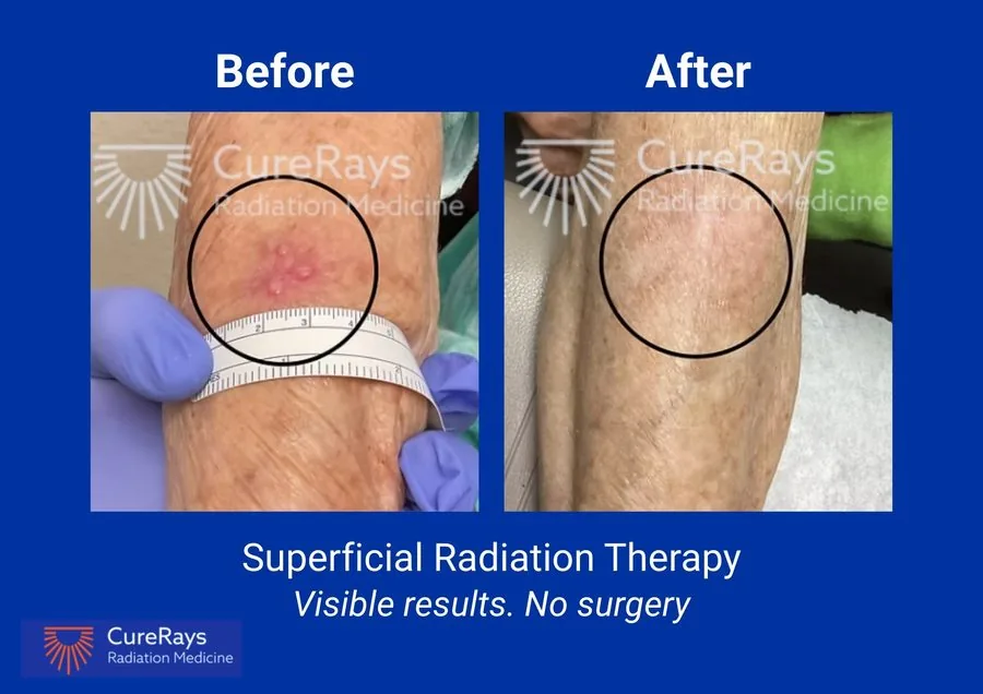 Before and after superficial radiation therapy — lower leg