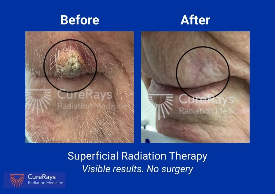 Before and after superficial radiation therapy — lip