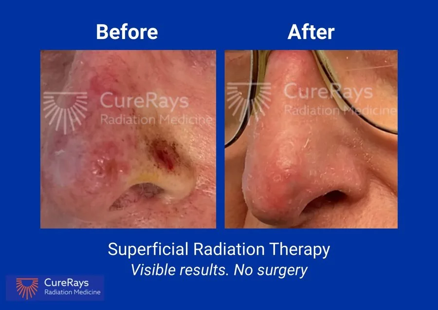 Before and after superficial radiation therapy — nose
