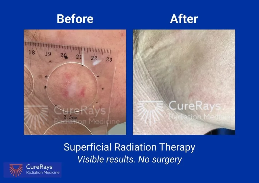 Before and after superficial radiation therapy — trunk